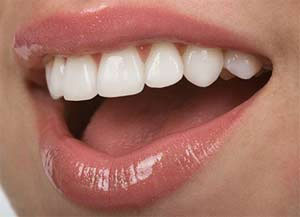 Виниры – средство для реставрации зубов и нивелирования их дефектов